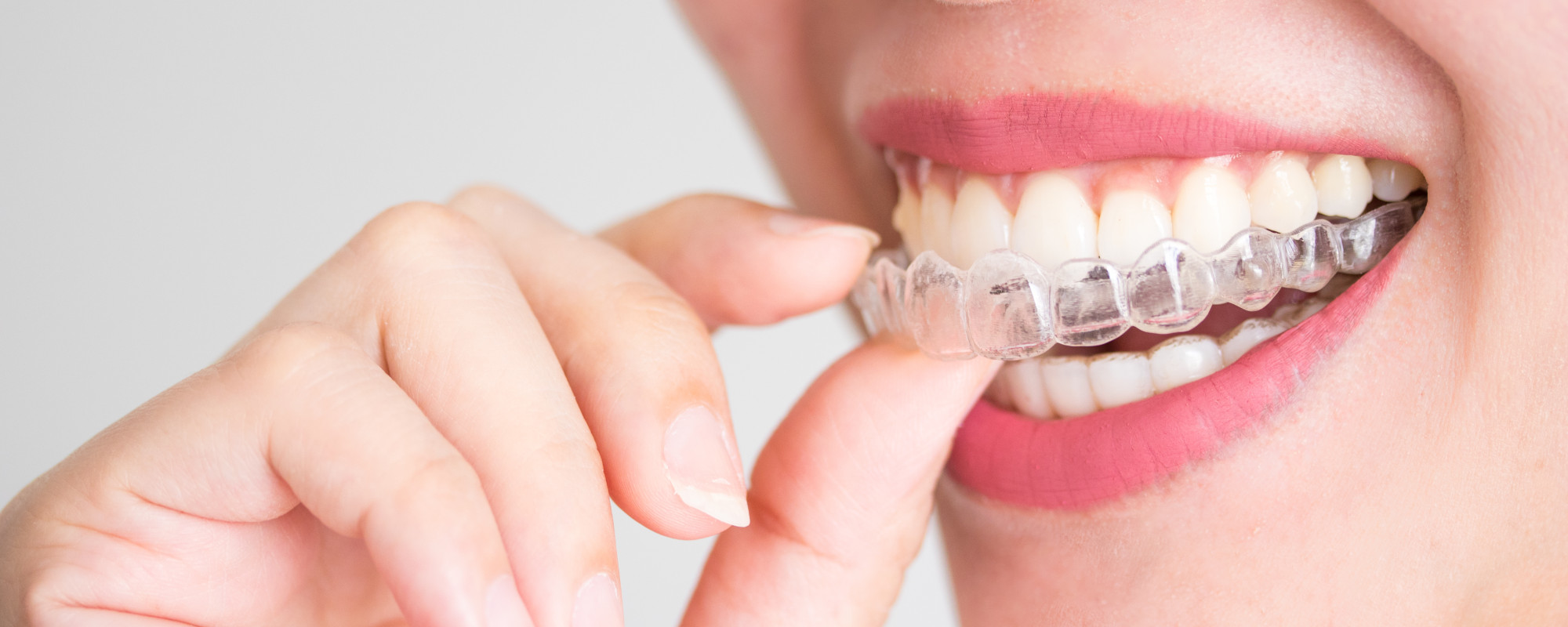 Invisalign Clear Aligners banner